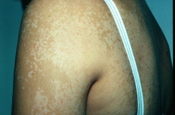 Pityriasis versicolor et mycoses - Pathologies - Surf Prévention